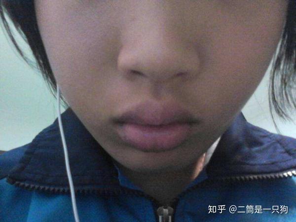 表现形式:唇部软组织太厚了,导致嘴唇有外