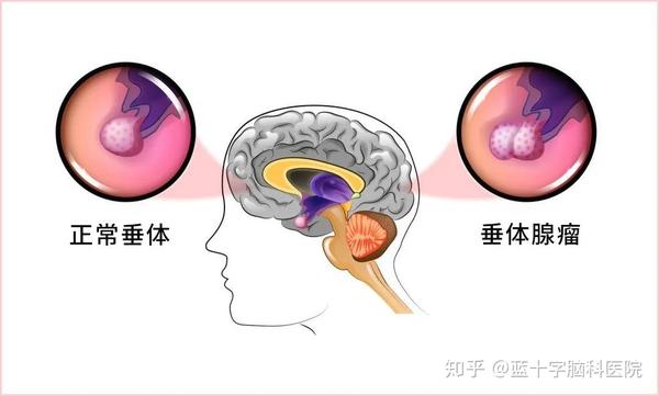 a,泌乳素垂体瘤(prl)