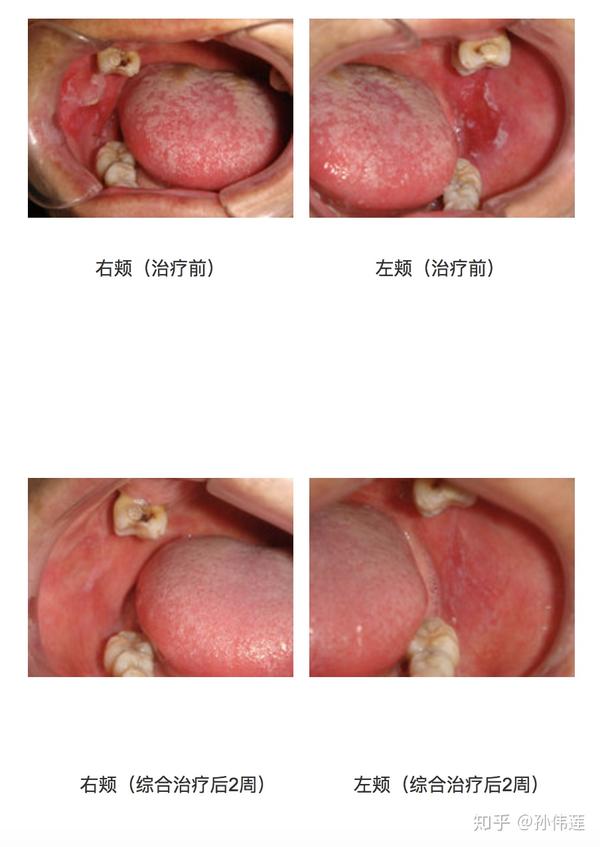 关注口腔黏膜扁平苔藓及治疗病例