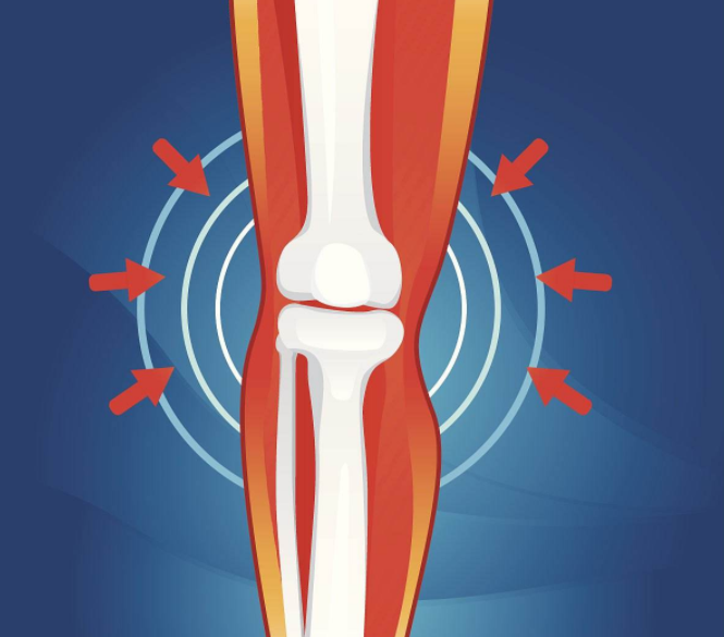 高诊无忧关节损伤检查方案之膝关节损伤的特点有哪些?