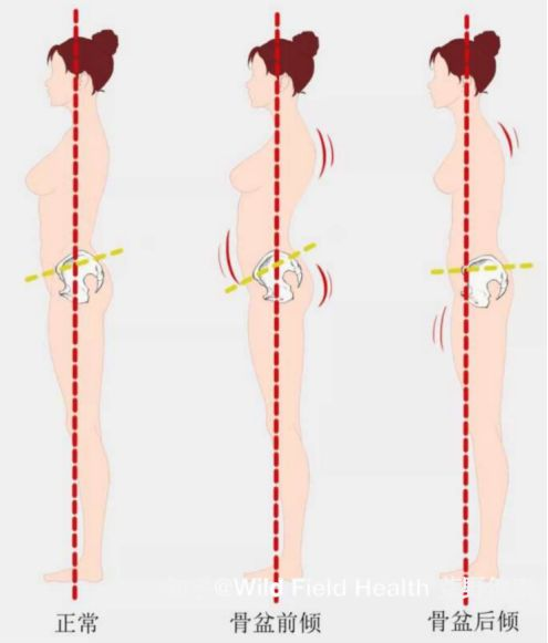 骨盆前倾容易带来的问题:  撅屁股,腹部向外突出,背部向后打开 长时间