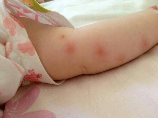 宝宝被蚊虫叮咬了,如何护理和预防?
