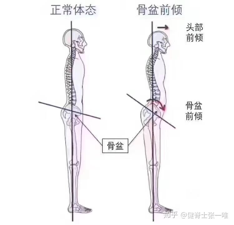 骨盆前倾的体态下,腰椎更加前凸,腰椎间盘之间的压力增大.