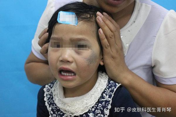 尤其是一些小孩子出生之后,你会发现有一些婴儿身上有太田痣这一类型
