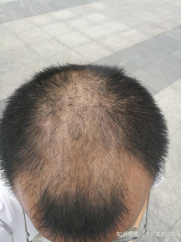 男性40岁头顶掉头发快秃顶了怎么办?