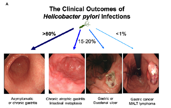 幽门螺杆菌感染使正常胃黏膜变为非萎缩性胃炎,进一步发展为萎缩性