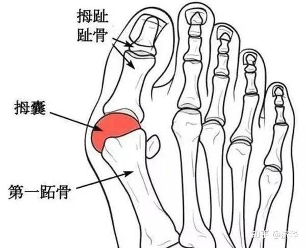 1:大拇趾根部的关节肿胀,发红或酸痛 2:出现老茧,由拇趾和第二趾互相