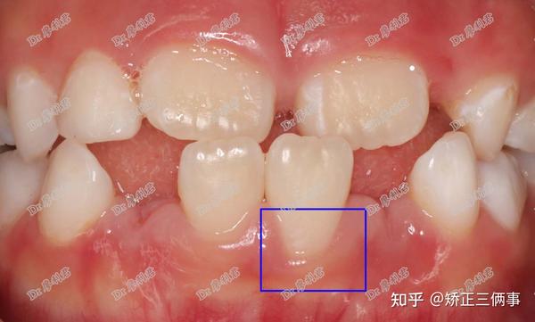 牙齿反合(又名地包天,兜齿),小朋友矫正了吗?