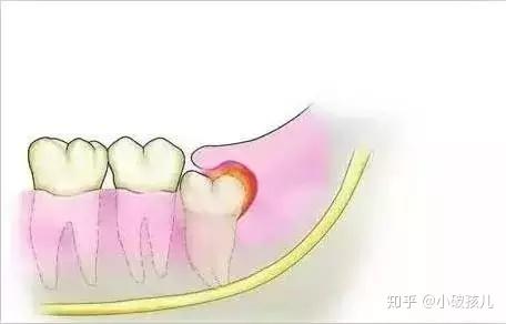 智齿冠周炎的危害及治疗方法