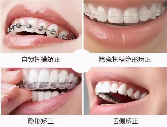 牙齿矫正会后悔吗后悔没早点做湖北地区正畸攻略