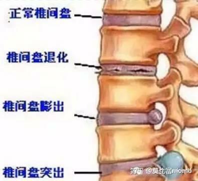 腰间盘突出,能康复吗?还是只能缓解?做什么运动好?