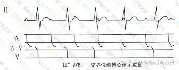 第三步分析观察qrs波群