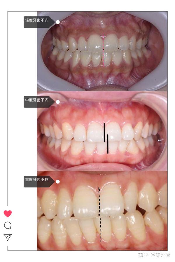 一般导致牙齿中线不齐的原因有两种: ①先天性牙齿缺失牙;②后天牙齿