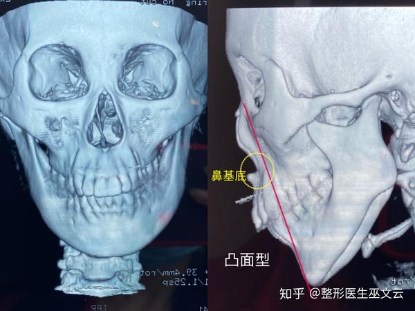 (鼻基底高于鼻根到下颏最高点的连线)