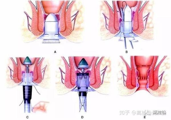 pph手术到底是什么?