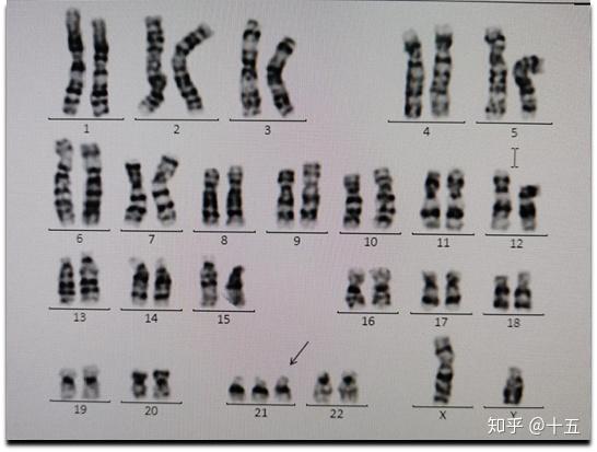 三体综合征,俗称先天愚型,是迄今为止大家最常见的,认识最深的染色体