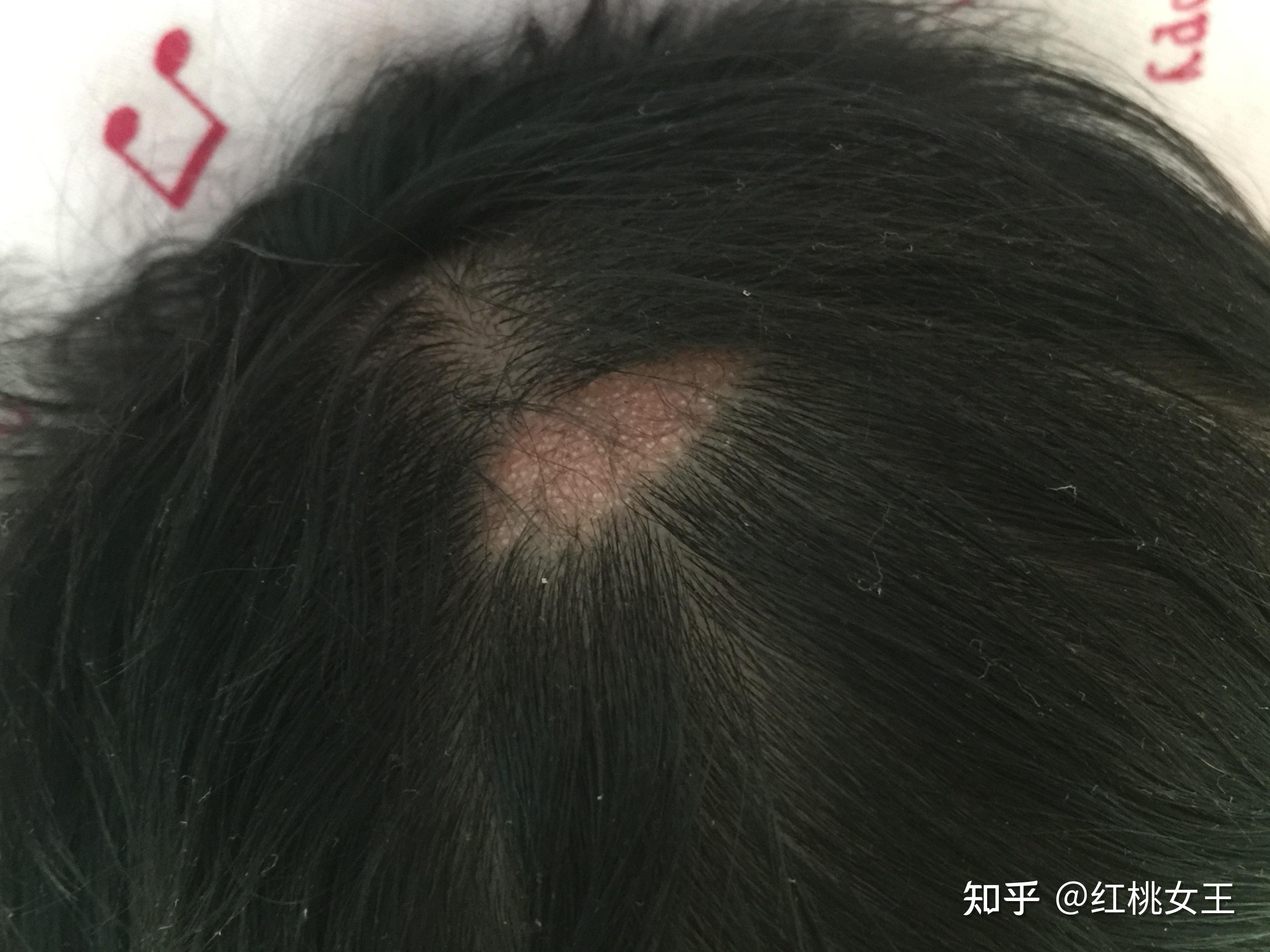 你知道皮脂腺痣和治疗方法吗
