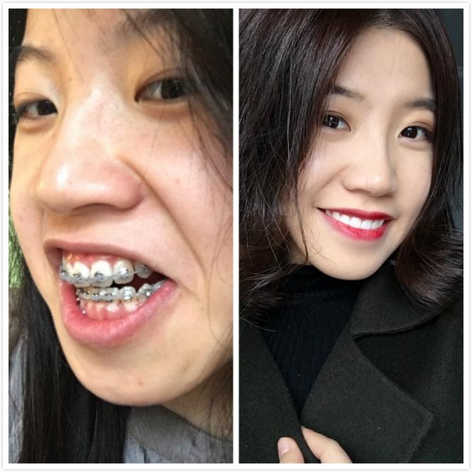 正畸分享戴牙套三年中途换了医生终于是一口漂亮的大白牙
