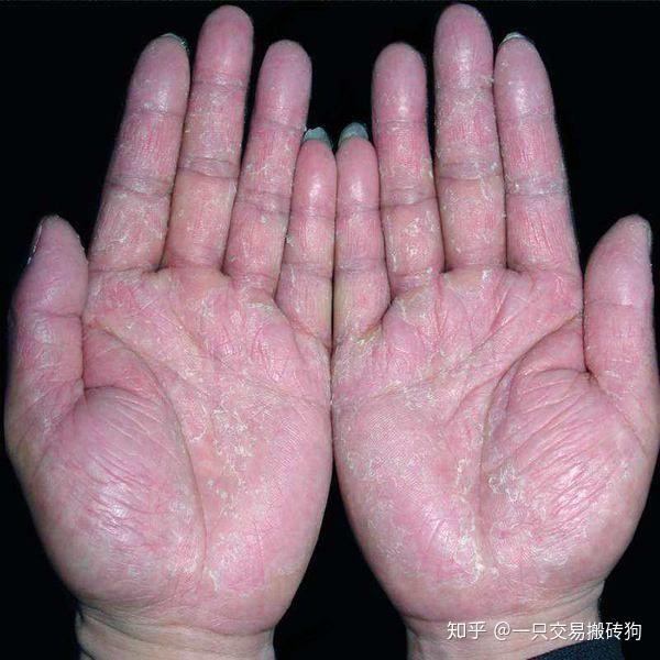 手脚出汗,手脚容易发红发热,季节性蜕皮,有小水泡,其实就是汗疱疹或者