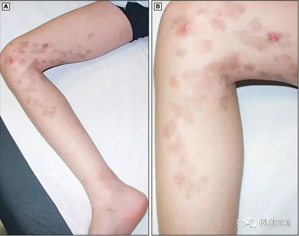 (单侧线状毛细血管炎,参考 3)