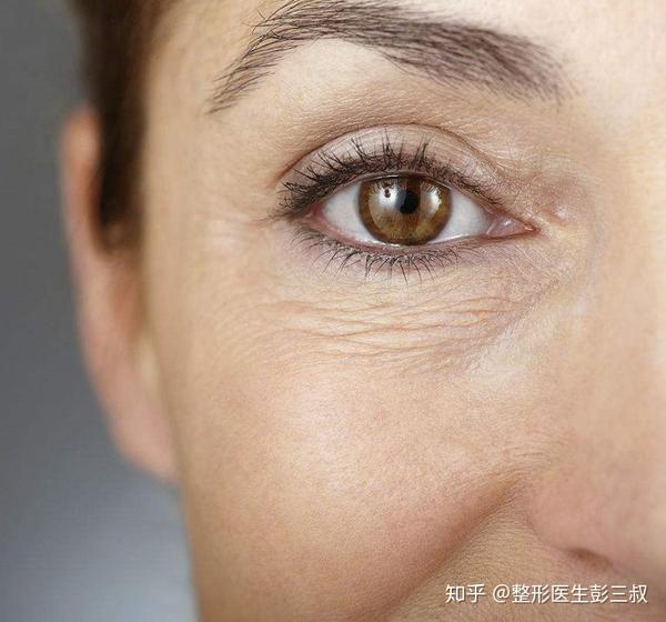 有下眼纹了怎么办