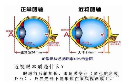 戴眼镜到底会不会使眼睛变凸?