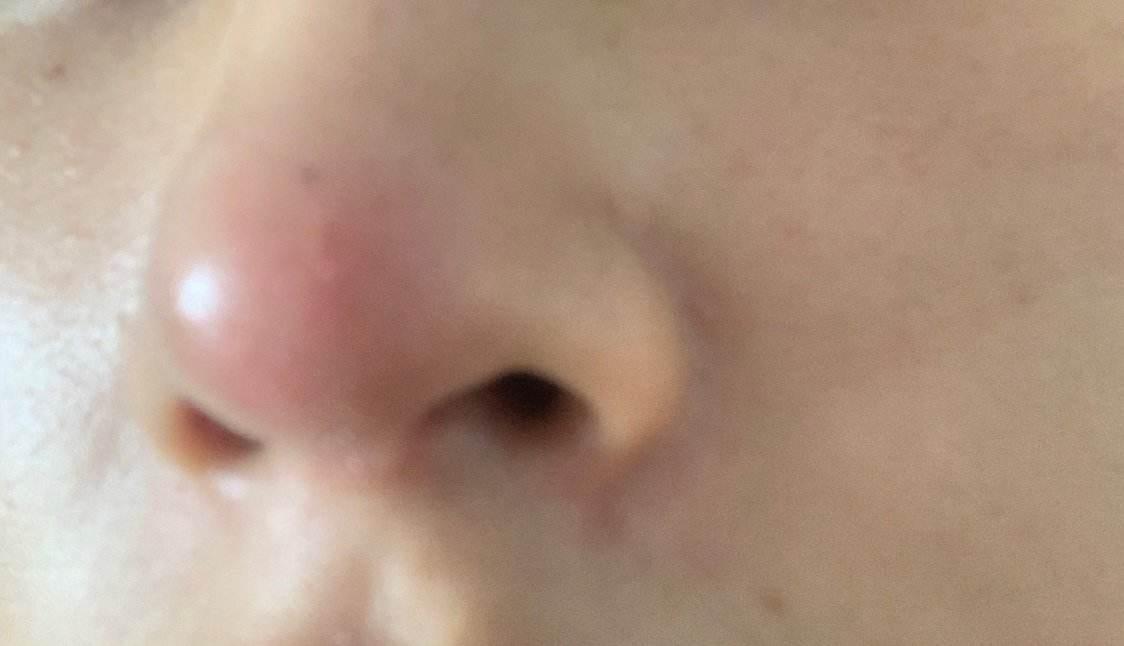 鼻子发红说明什么问题可能是疾病的信号