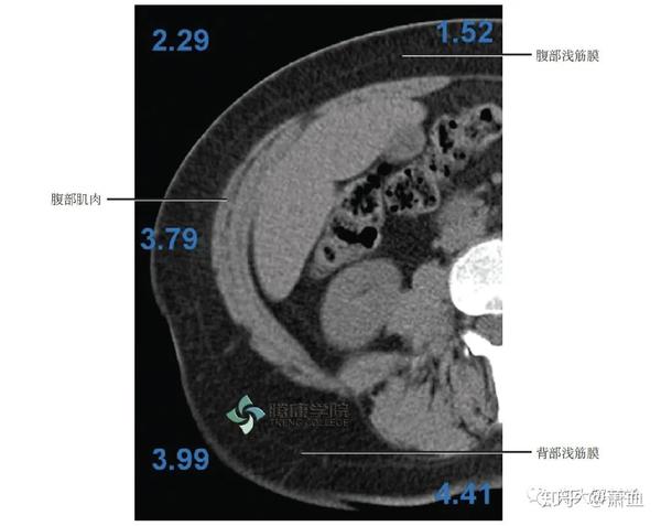 腹部ct扫描