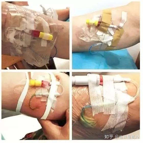 严重者会有穿刺点的红肿,渗液,化脓及导管相关性血流感染
