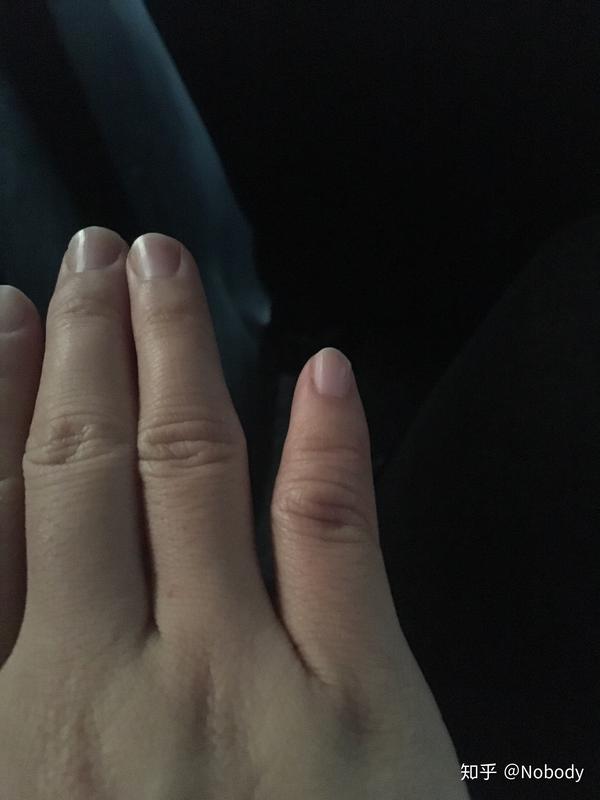 我的小手指是这样的,算是一种畸形吗?