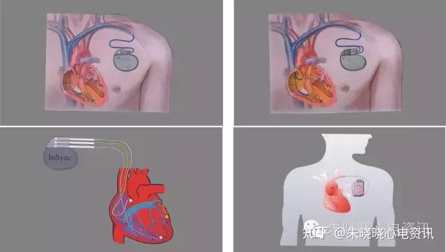 人工心脏起搏系统主要包括两部分:脉冲发生器和电极导线.