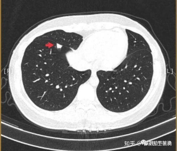 有肺癌转移风险;如果直接手术,又有很多炎症性良性结节,被认为肺癌而