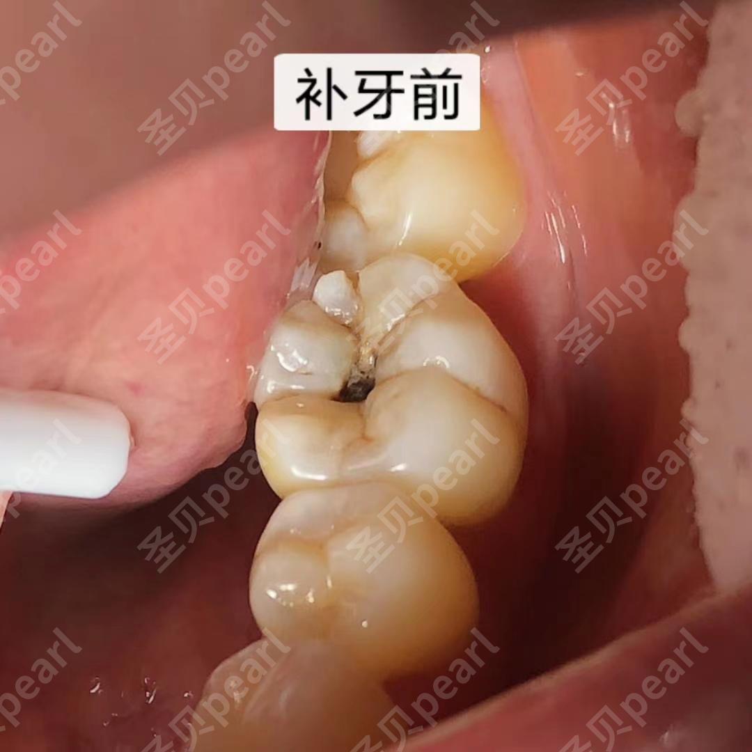 北京圣贝口腔:【补牙案例分享】牙齿出现肉眼可见的黑洞时,往往已经龋
