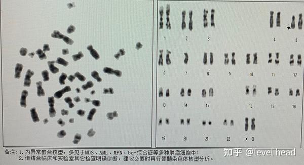 1,5q-染色体异常 染色体异常核型