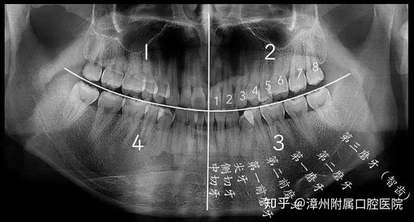 智齿该拔就得拔不然可能丢了小命