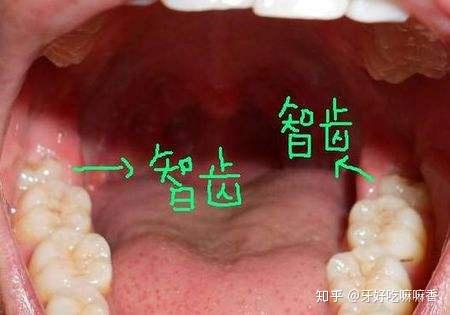 阻生齿 长智齿不但会造成口腔内牙齿排列不整齐,而且也会诱发阻生齿