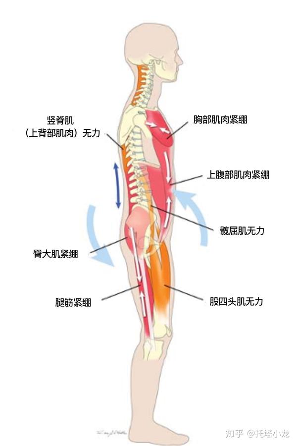 办公室一族依然是骨盆前倾的阵地人群,以致造成神经压迫,肩颈酸痛