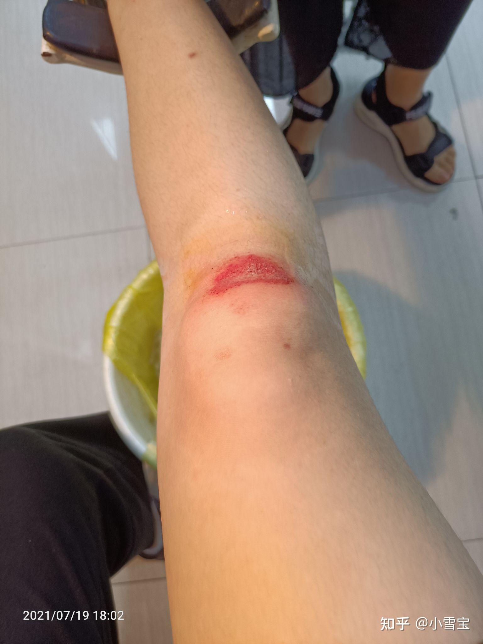 膝盖擦伤这样能快点好