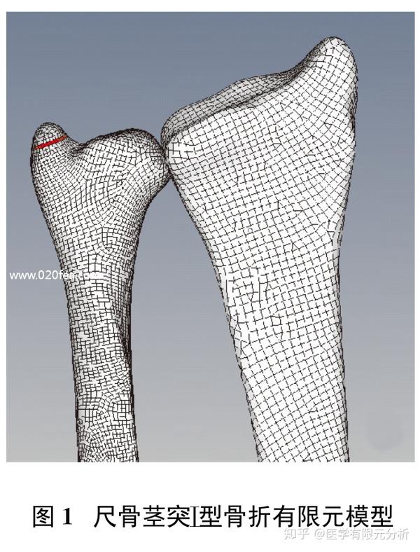 尺骨茎突骨折有限元模型的建立与力学分析