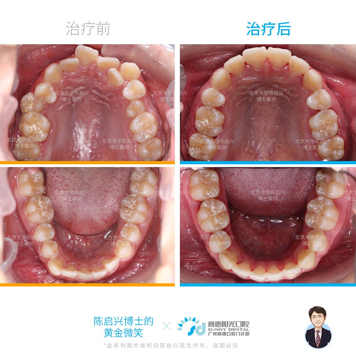 牙齿错乱拥挤还大小脸还有救吗