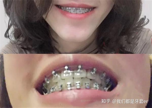 戴牙套490天的时候