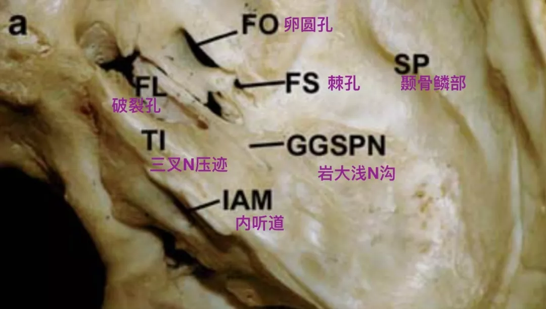 脑血管解剖学习笔记第2期棘孔的解剖