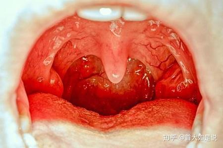 首大石萍为什么感冒总会引发扁桃体发炎