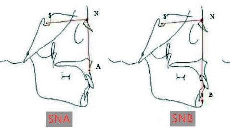 头侧位片判断骨性或牙性错颌