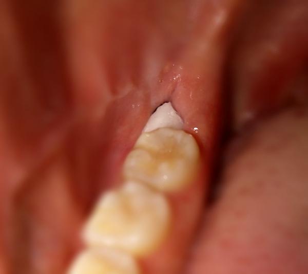 拔完智齿后拔智齿那一侧很臭?