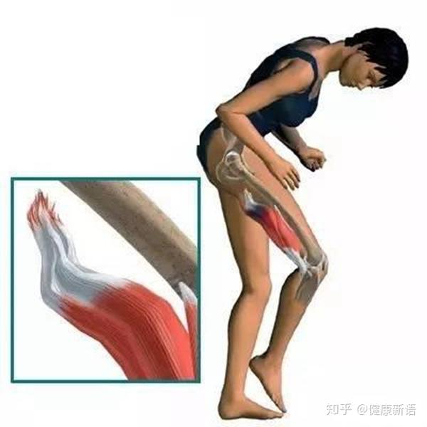 发生在大腿后侧的肌肉拉伤,腘绳肌是很重要伸髋肌和屈膝肌肉,当腘绳
