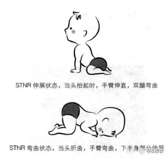 上肢伸展而下肢屈曲,臀部坐着脚踝上,这就是对称性紧张性颈反射(stnr)