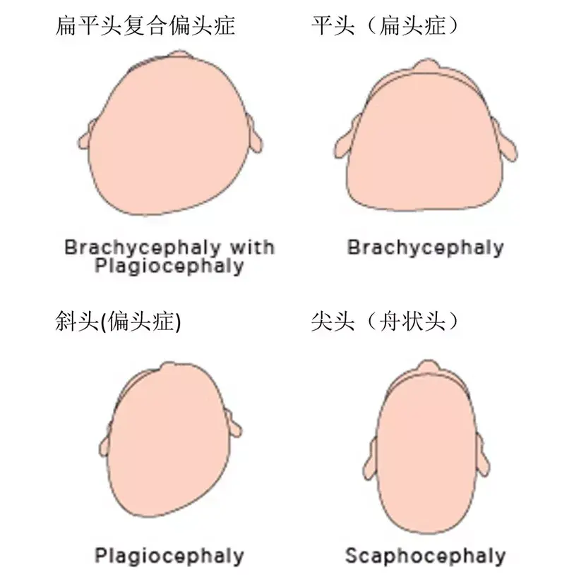 不过,扁头综合征里可不止有扁头一种,还有斜头(偏头,尖头(舟状头)