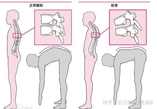 腰痛系列之竖脊肌
