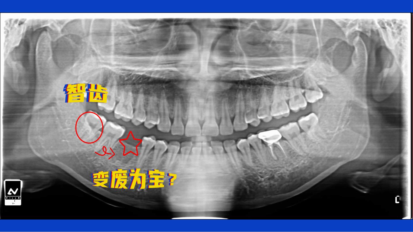 在广东省口腔医院拔智齿的经过 - 知乎